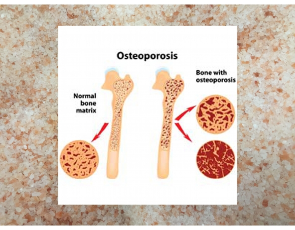 Himalayan pink salt for Arthrosis and Osteoporosis